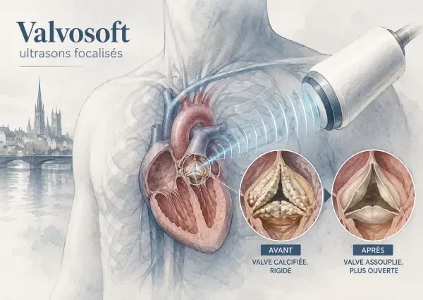 Valve cardiaque traitée par ultrasons